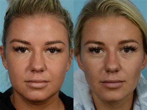 buccal fat removal leeds|Buccal Fat Removal: What It Is, Recovery & Before & After.